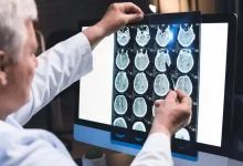recent-legal-trends-for-brain-injury-cases-in-california